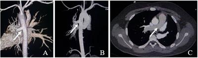 Surgical treatment of anomalous origin of the left pulmonary artery from the descending aorta in a teenager: a case report